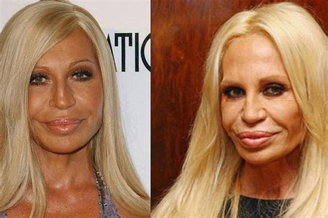 donatella versace cirugias plasticas|¡Abusó de las cirugías! El antes y después de Donatella Versace.